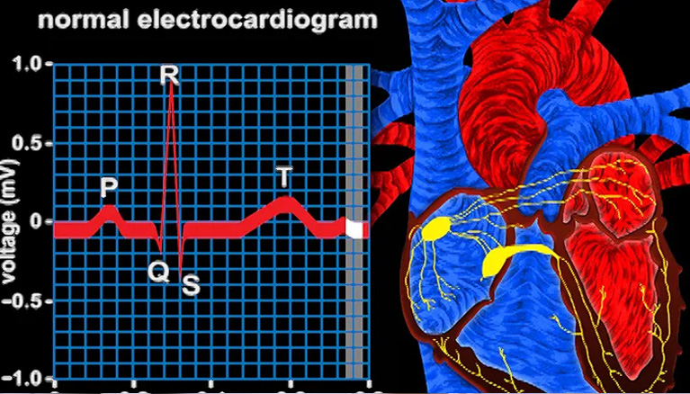 ECG